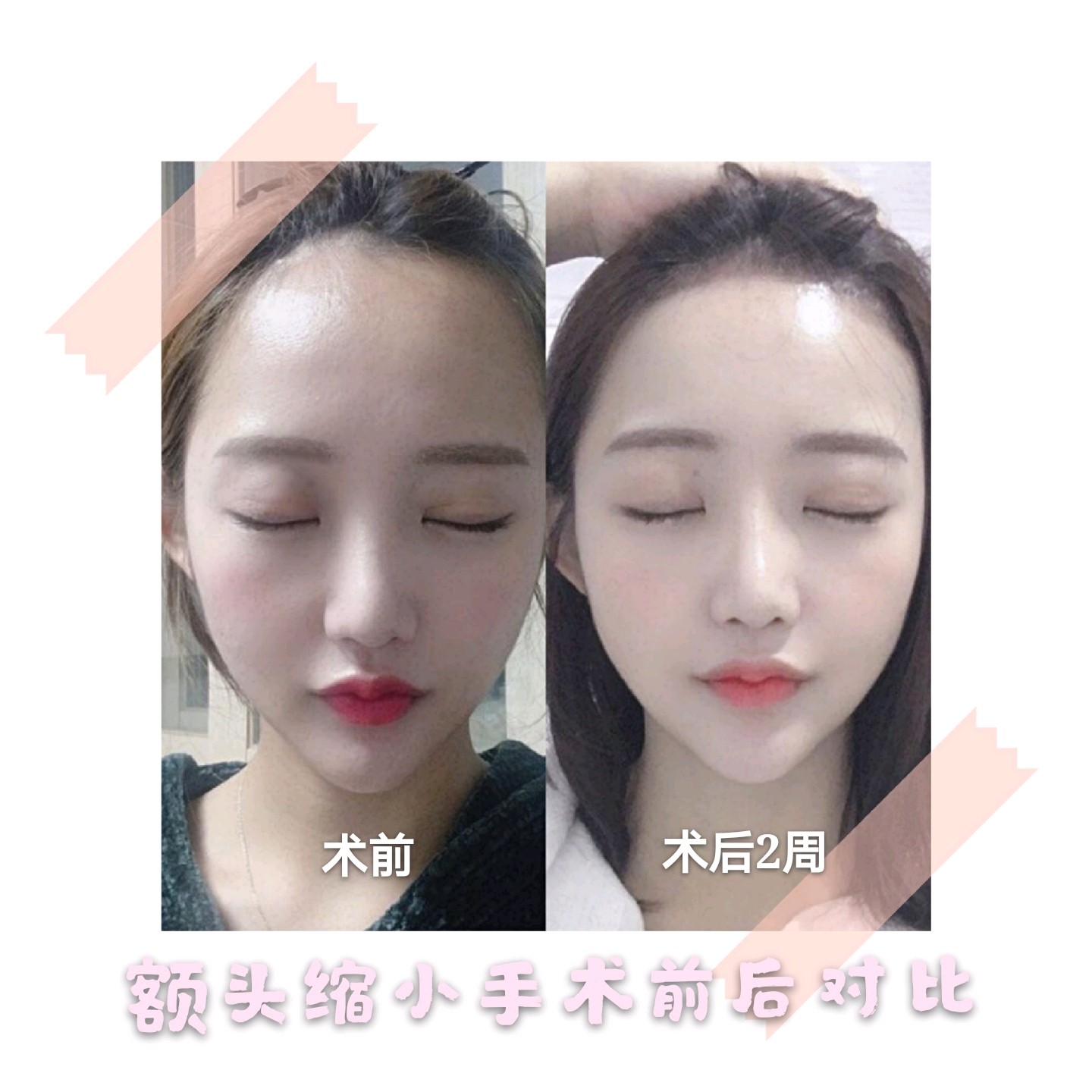 【额头缩小术后反馈~】