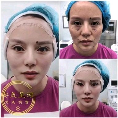 这就是桃花面,全脸360无死角抗衰,无痛无创,瞬间_圈子-新氧美容整形