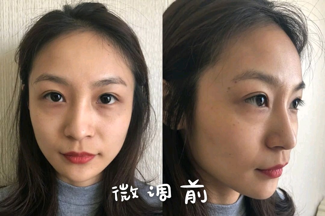 全面部微调美白祛斑心得体验