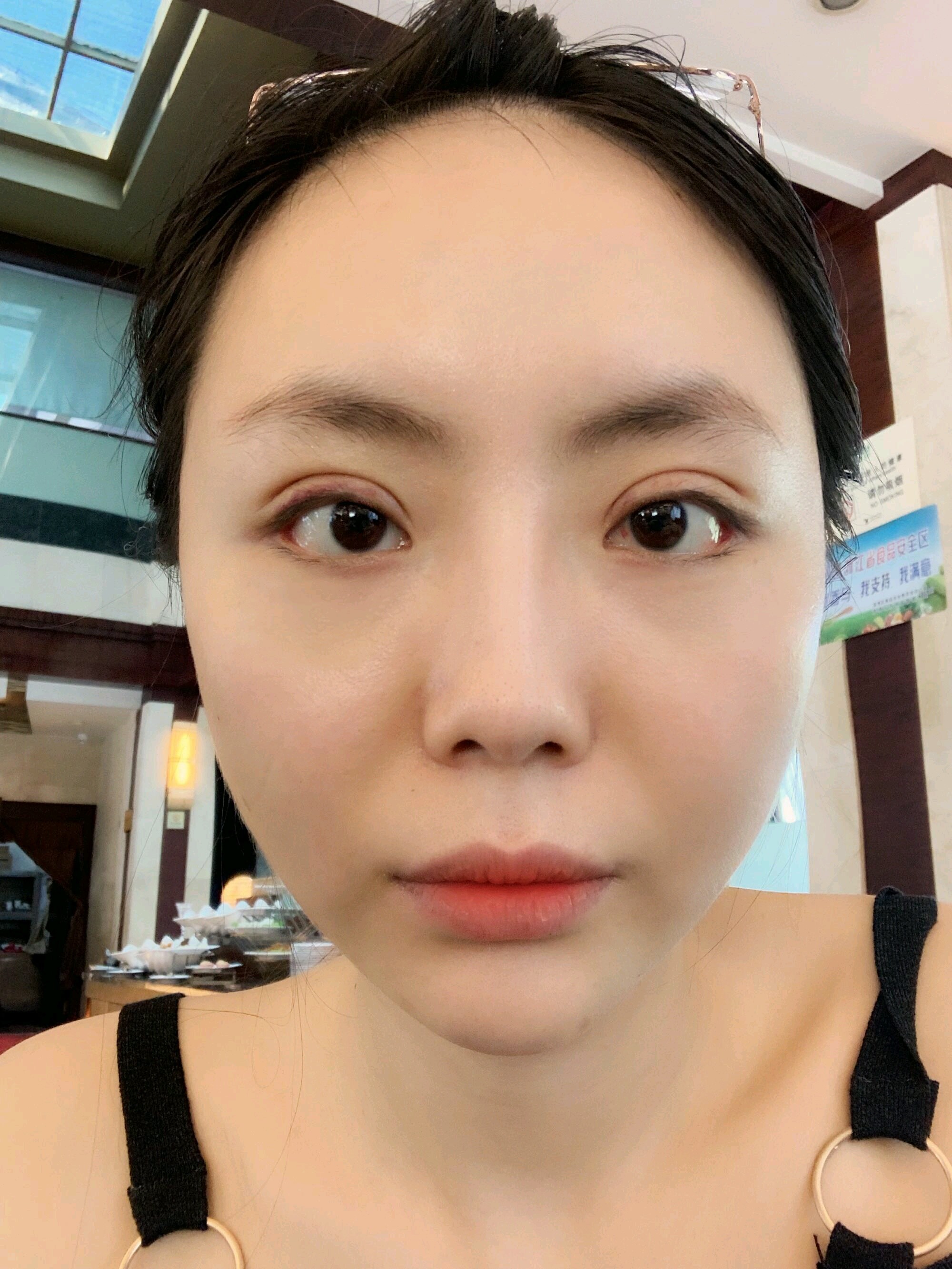 做了眼部多项四项全开:双眼皮 内眼角 外眼角 下至,_圈子-新氧美容