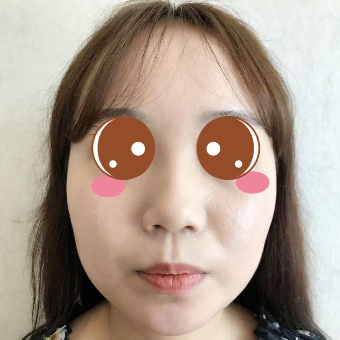 果然瘦脸针打完效果就是立竿见影的,刚打完咬肌还是有_圈子-新氧美容