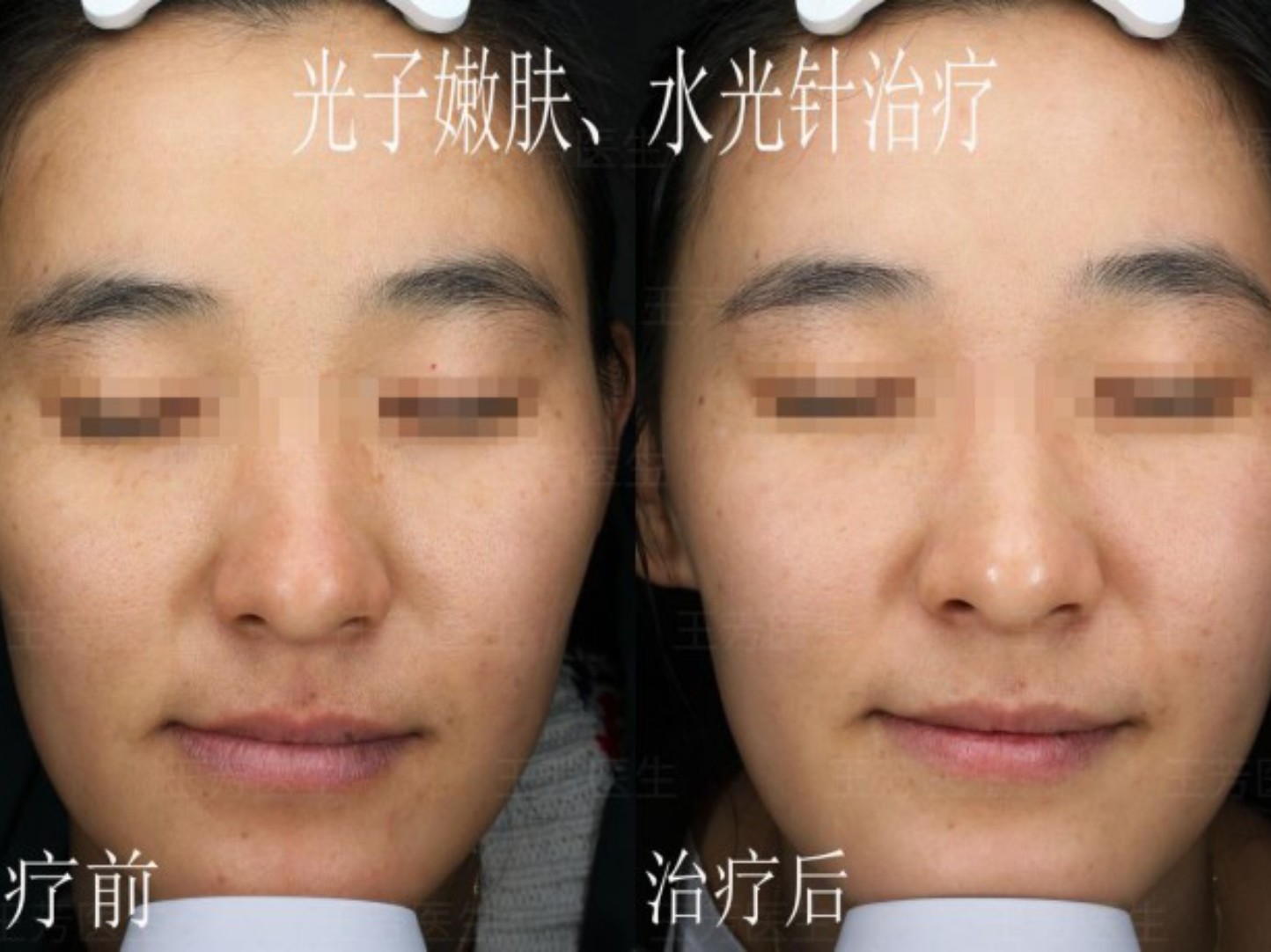 下图为光子嫩肤,水光补水治疗前后的对比照片,肤色明显提亮,肤质更加