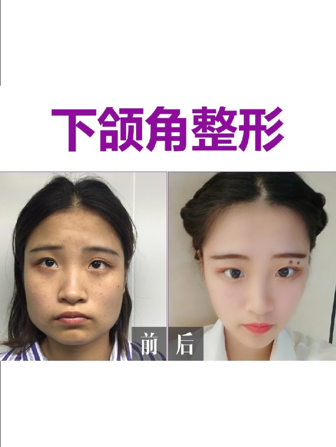 动了骨头老了面部就会垮塌