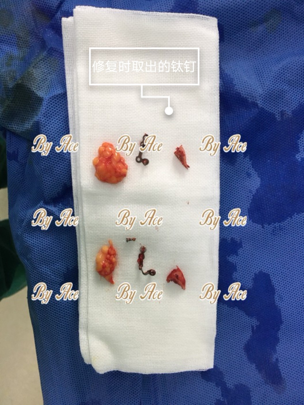 一年前在重庆做的颧骨内推