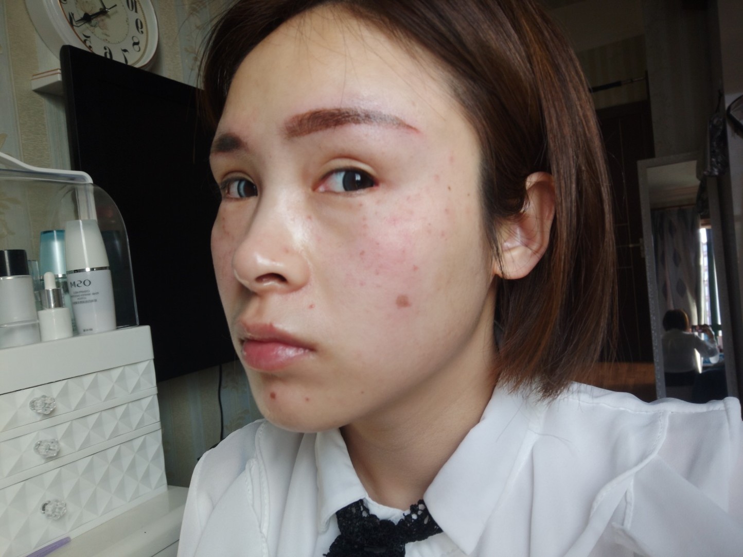 超皮秒第一天 脸上斑好多 ,想了很久来做 看起来有点吓人