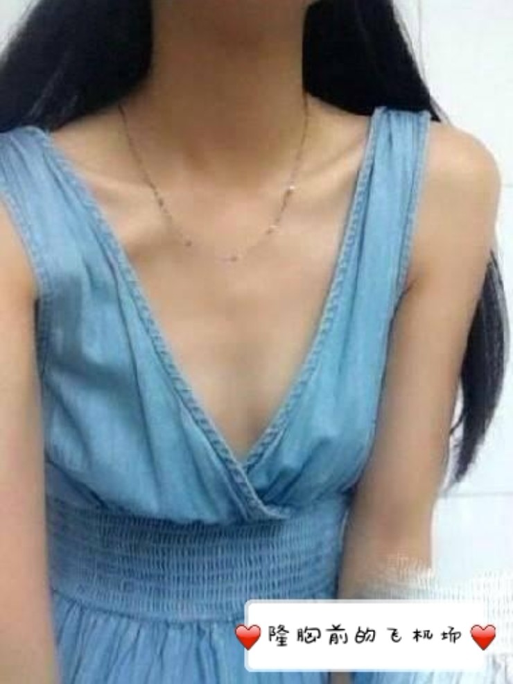 假体隆胸做个凹凸女人