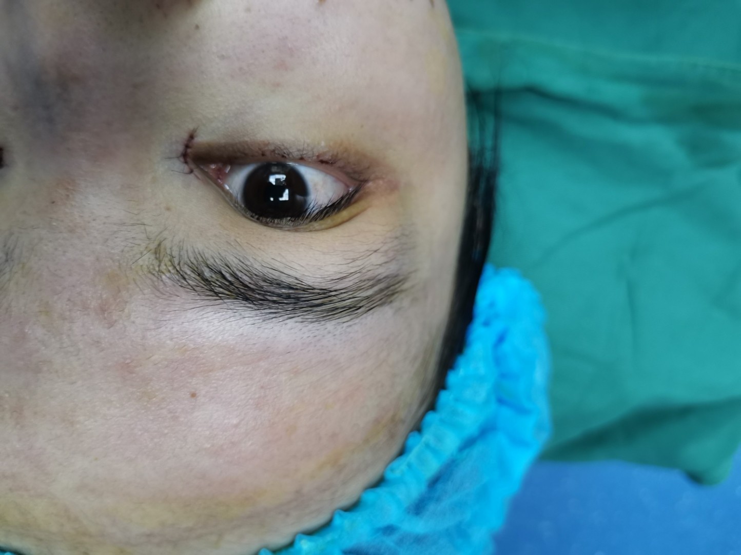 内眼角太包眼角了,好多人都说我应该做个开眼角,我自_圈子-新氧美容