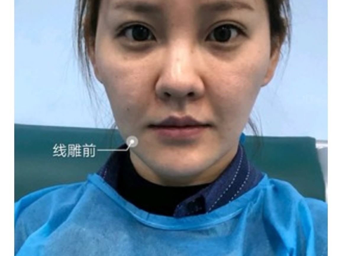 99年龄:33岁 90症状:线雕前面部凹陷泪沟法令纹松弛全齐了我的