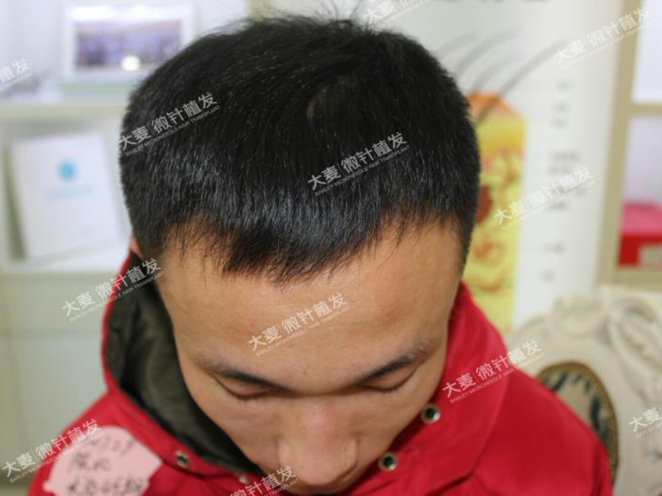 植发的方向不对(植发方向不对可以调整毛囊)