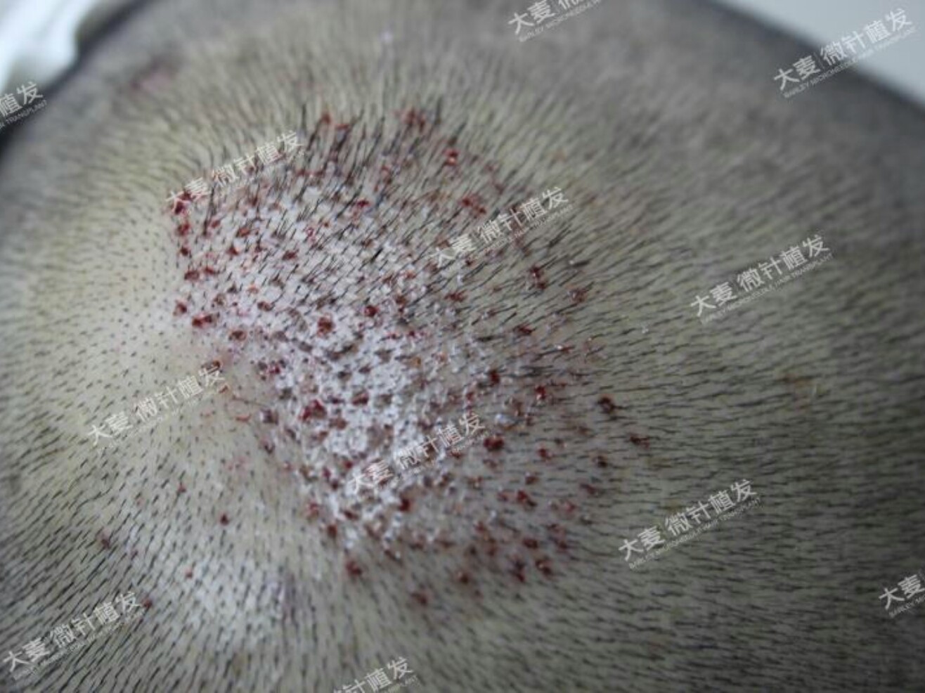 大麦微针植发术后1天,术后第二天血迹已经结痂了,不_圈子-新氧美容