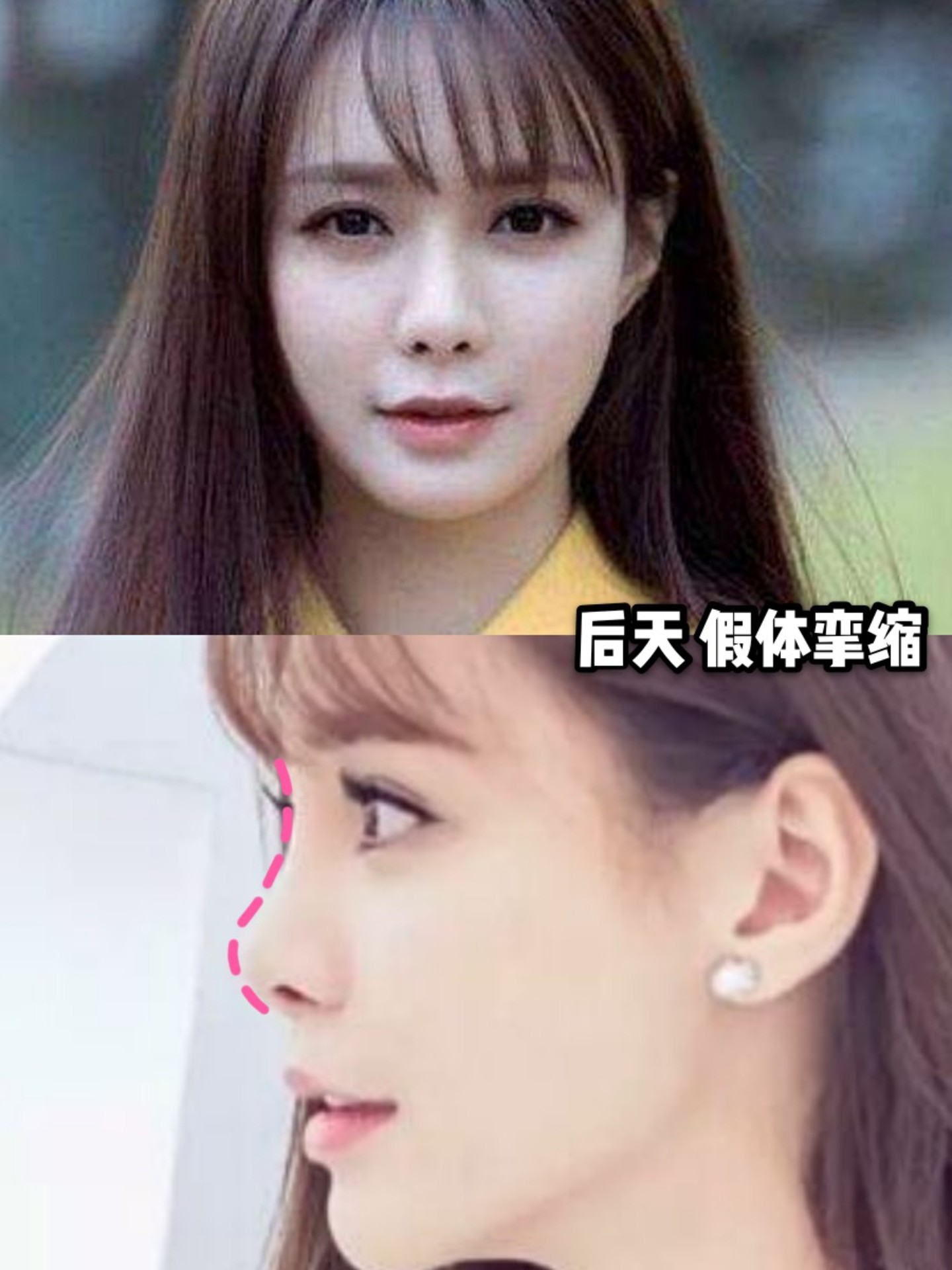 朝天鼻/猪鼻孔,鼻孔外露该怎么解决