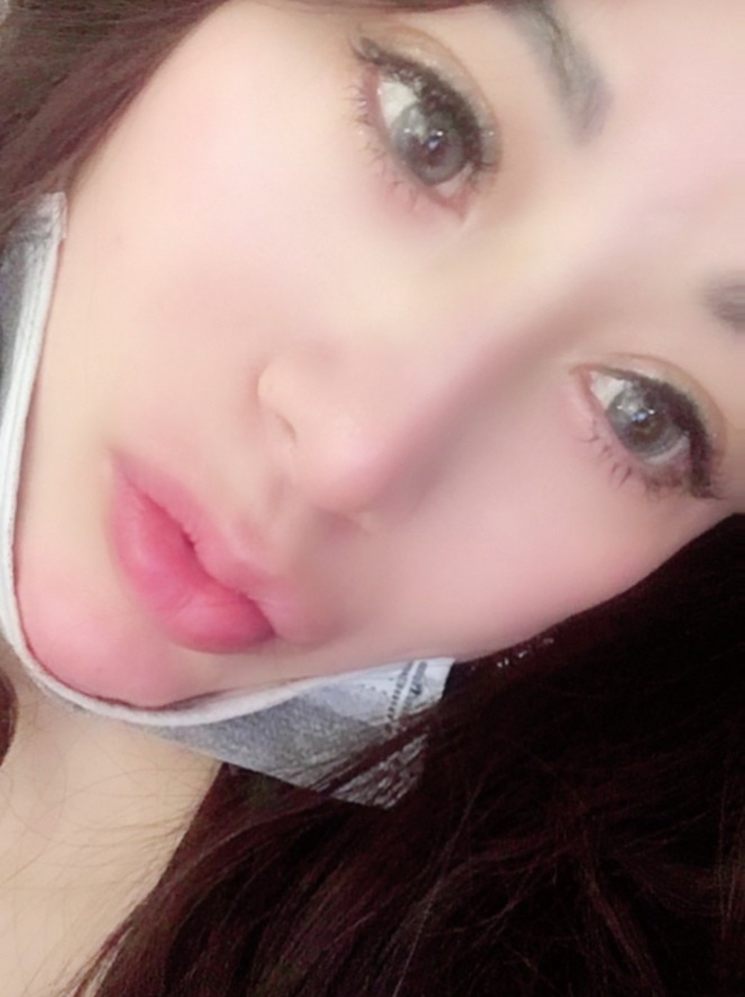 丰唇第二天,嘴唇水嘟嘟地很好看,打完也没有肿,效果挺好