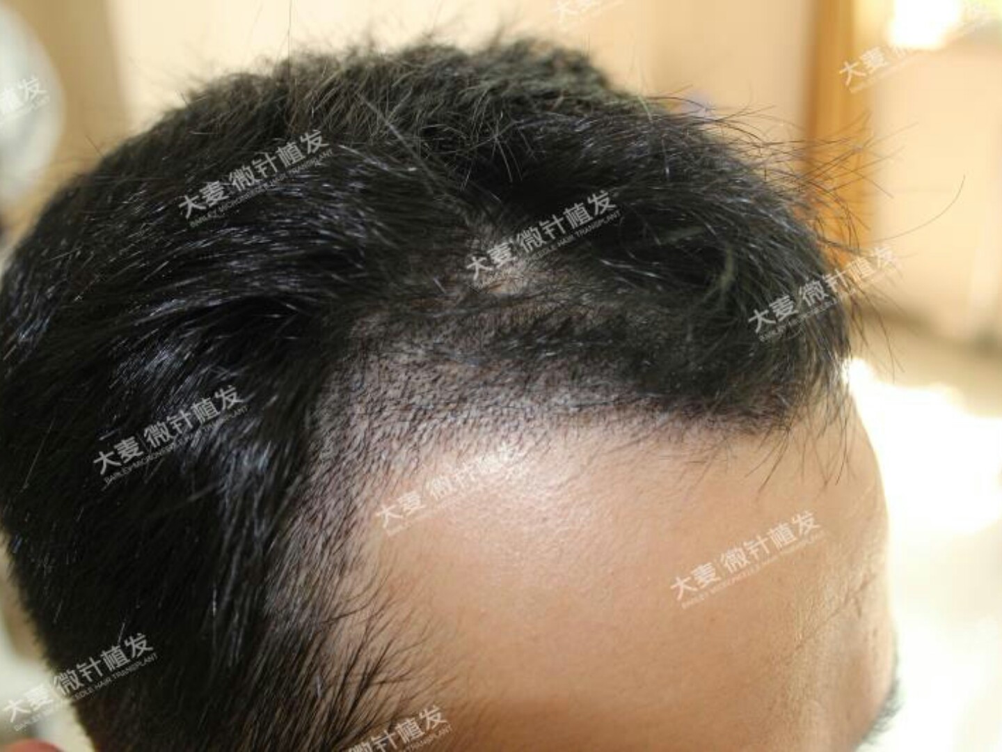 大麦微针植发术后9天,我的面积比较小,就两个小额角,所以清血痂的时候