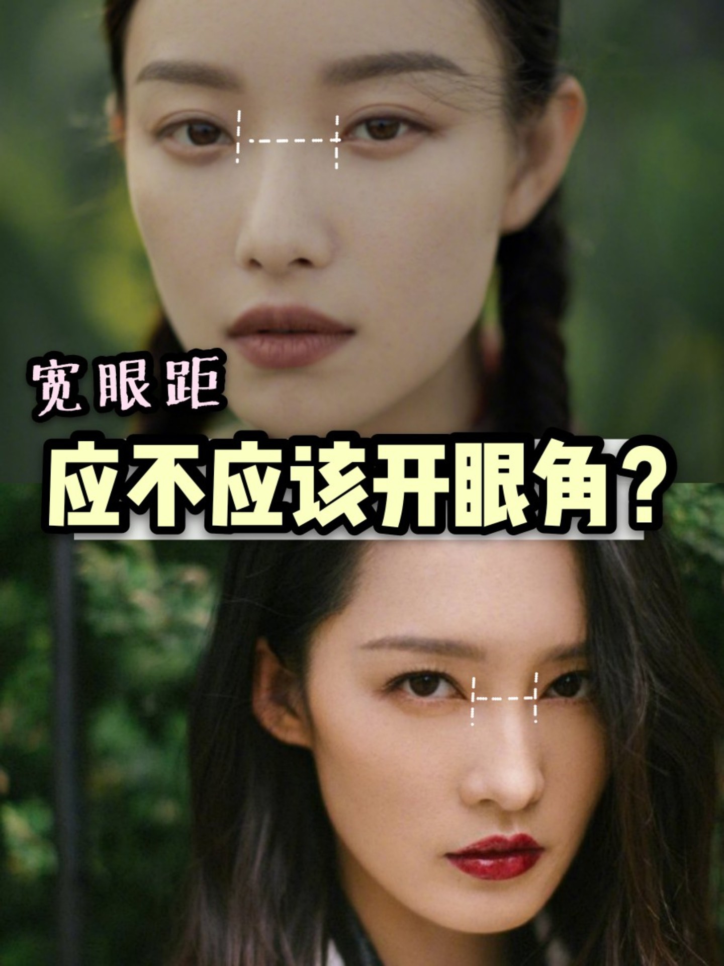 宽眼距95应不应该开内眼角71 .