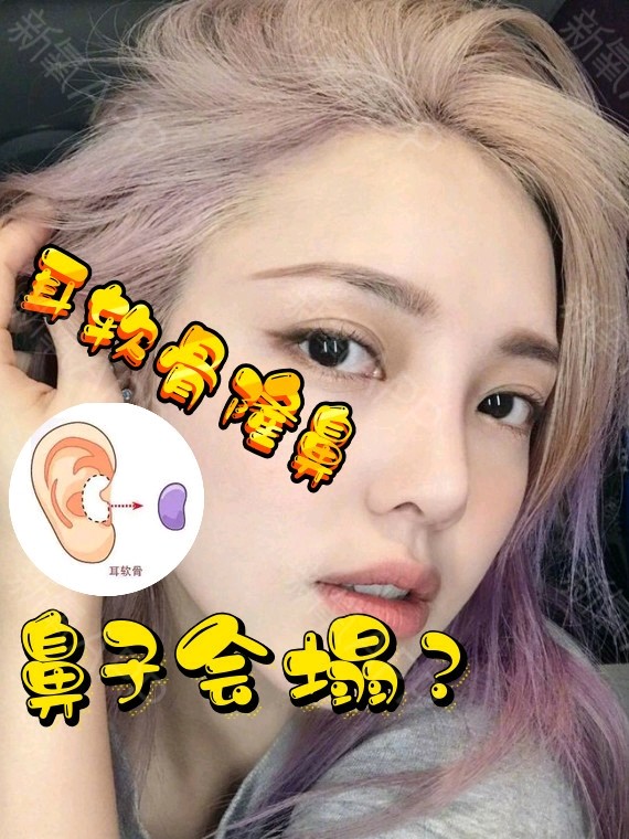 耳软骨隆鼻,鼻子会塌吗?