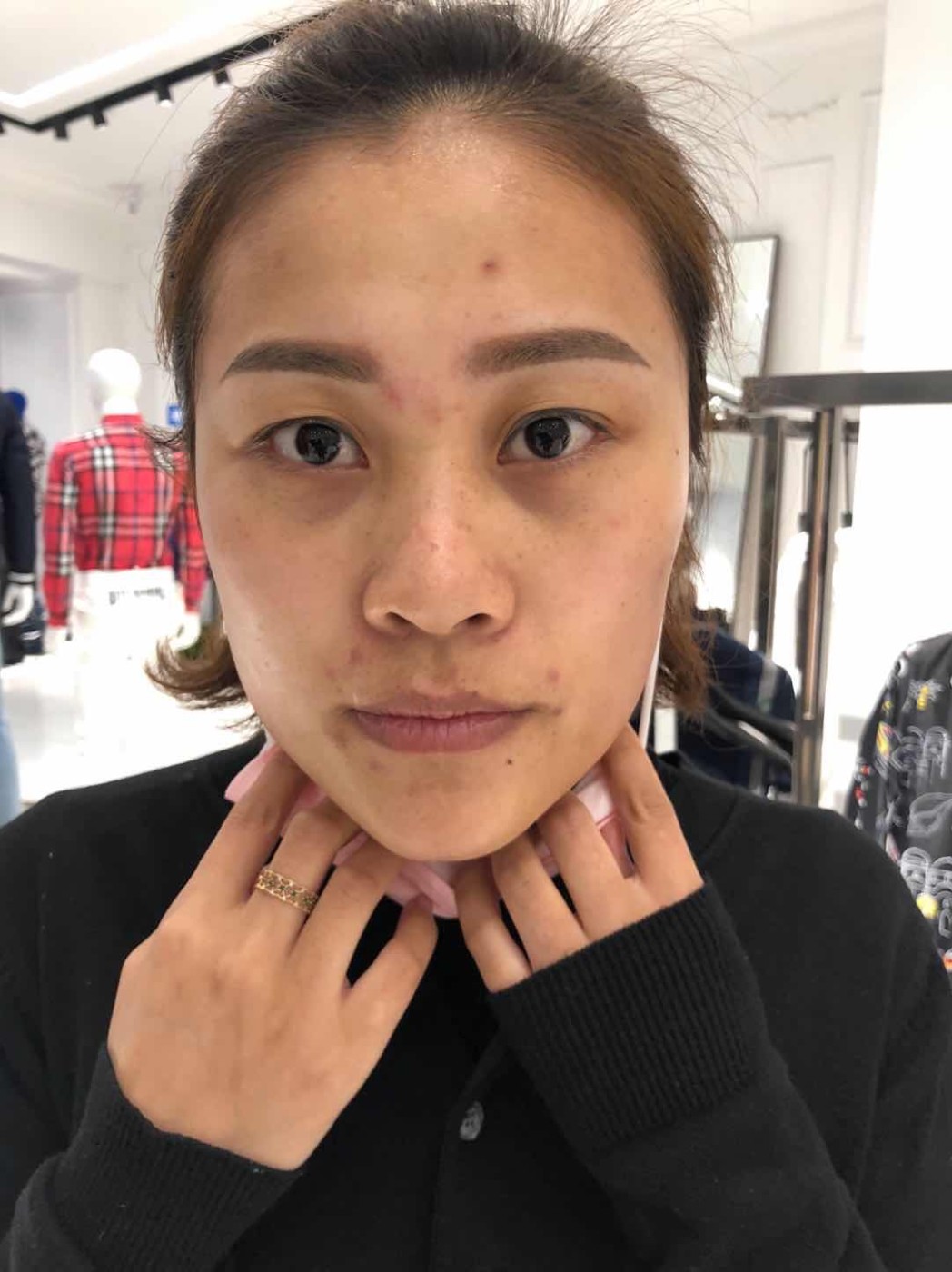 同一个角度,无美颜的三张照片,第一张3月8号没做之_圈子-新氧美容整形