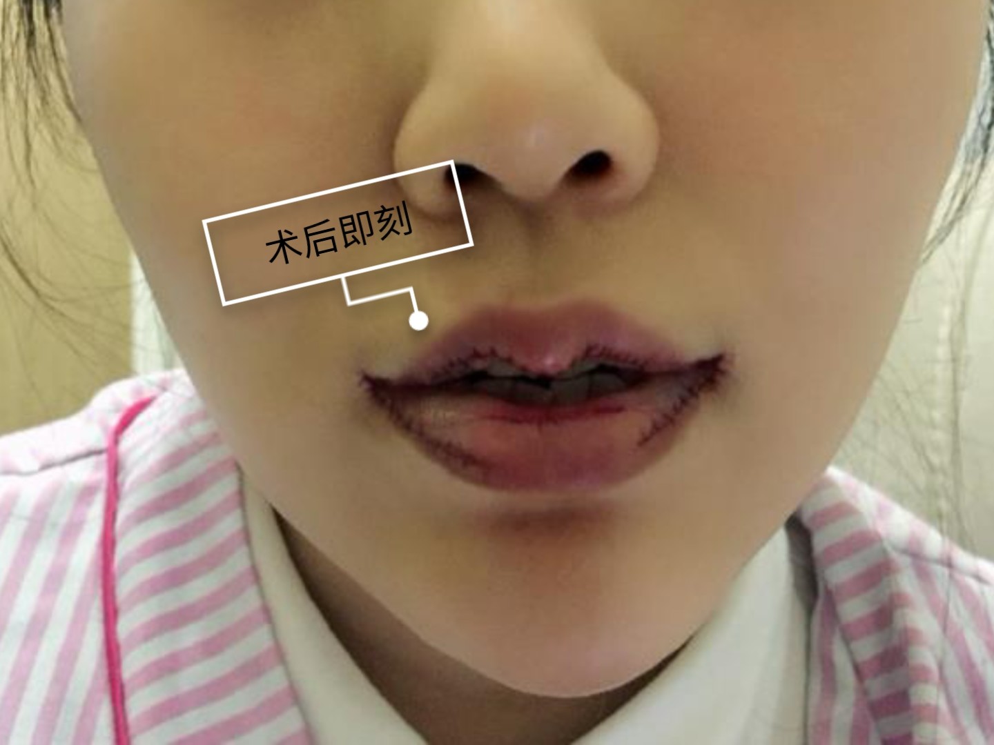 俏皮上扬微笑唇今天下午刚在致臻爱做了嘴巴93,现在_圈子-新氧美容