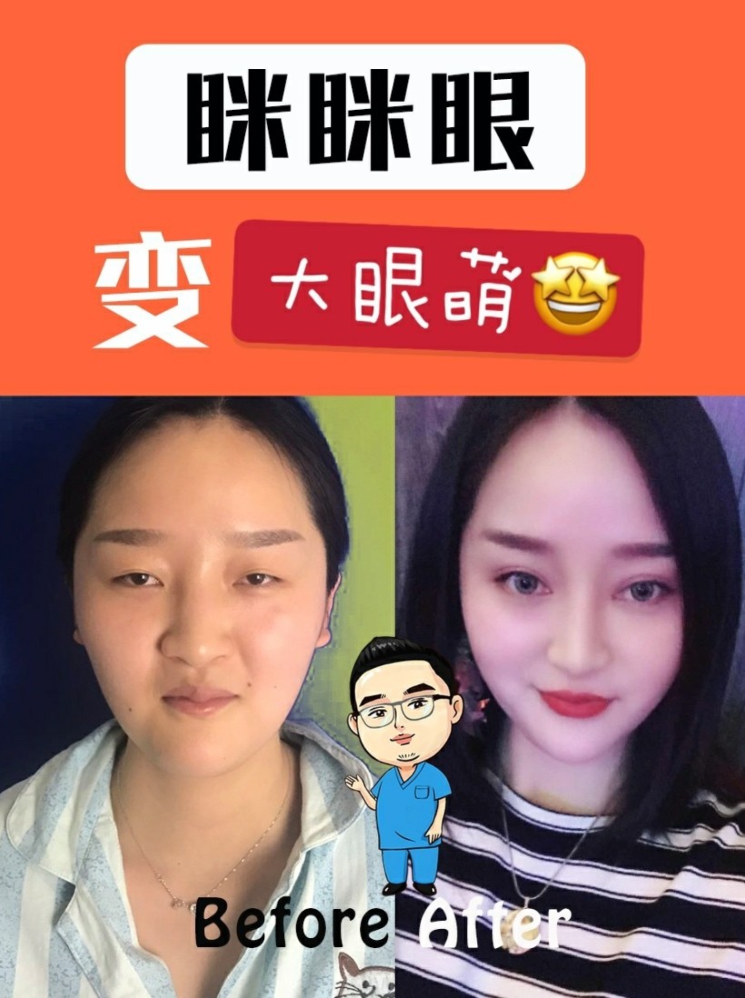 眯眯眼变大眼萌,双眼皮案例
