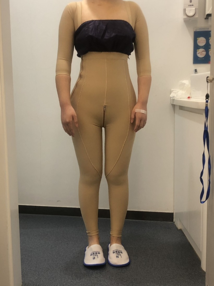 全身吸脂第二天下地走路没影响