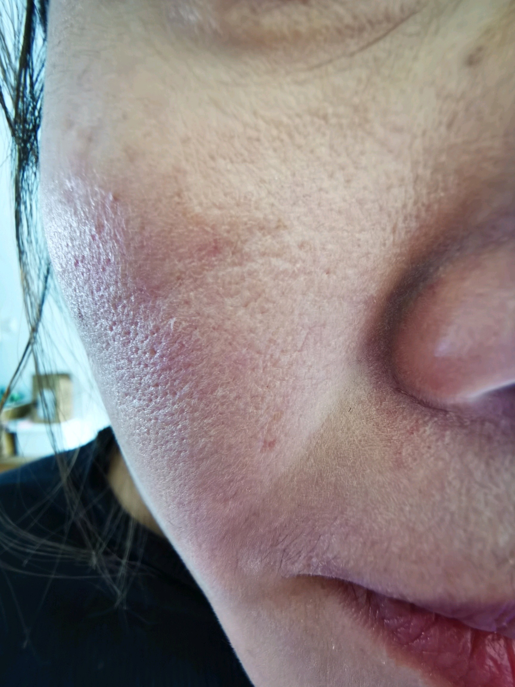 点阵激光一次后整个侧脸也出现了毛孔粗大疤痕体质是不是没有胶原蛋白