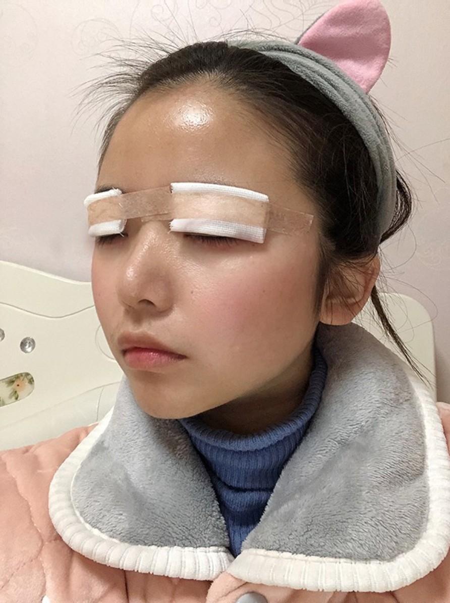 【壹加壹双眼皮手术日记】今天是做双眼皮的第一天,看_圈子-新氧美容