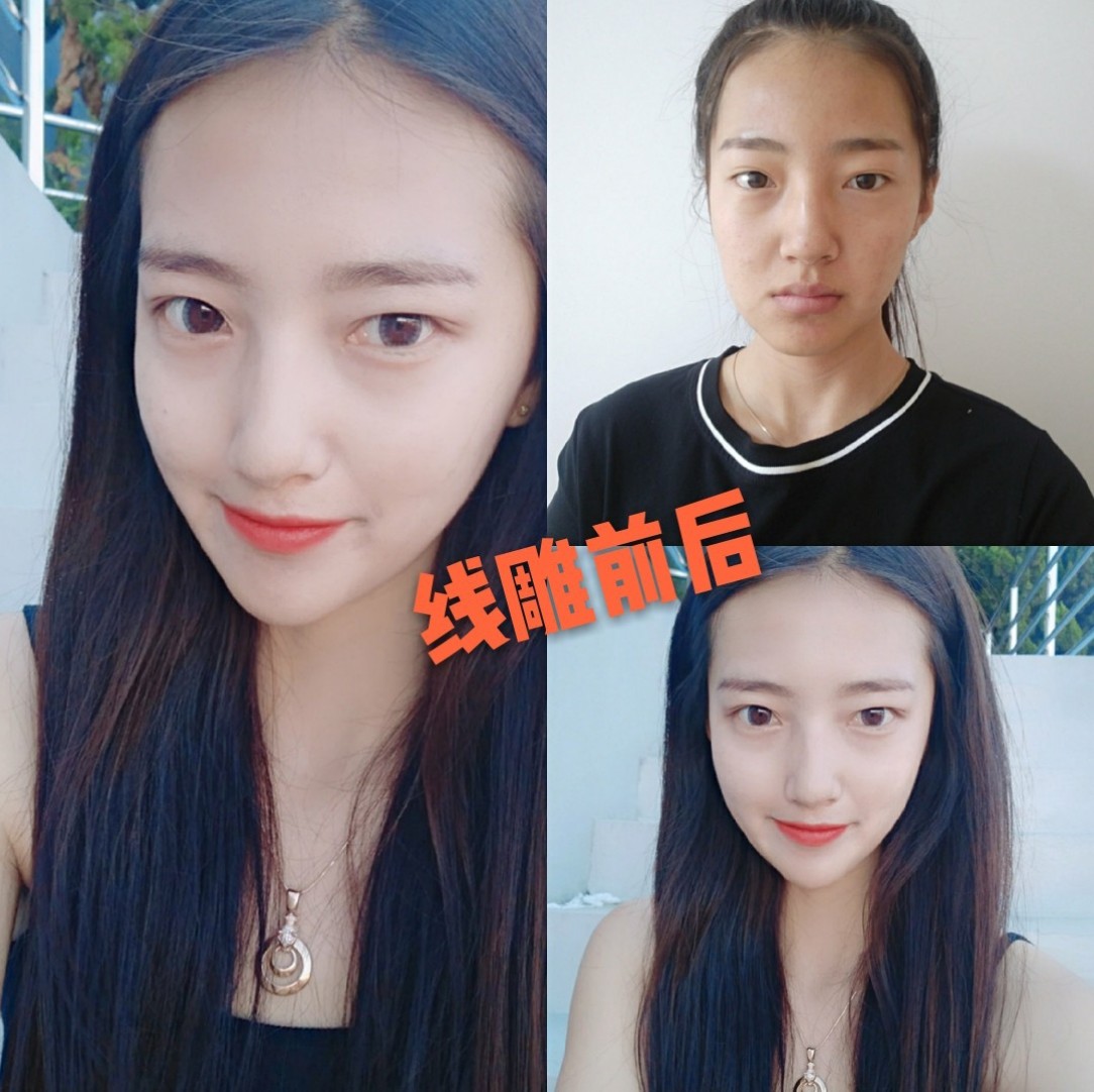 我的闺蜜做了线雕术后已经满30天啦,想跟大家分享她的记录和心得体会