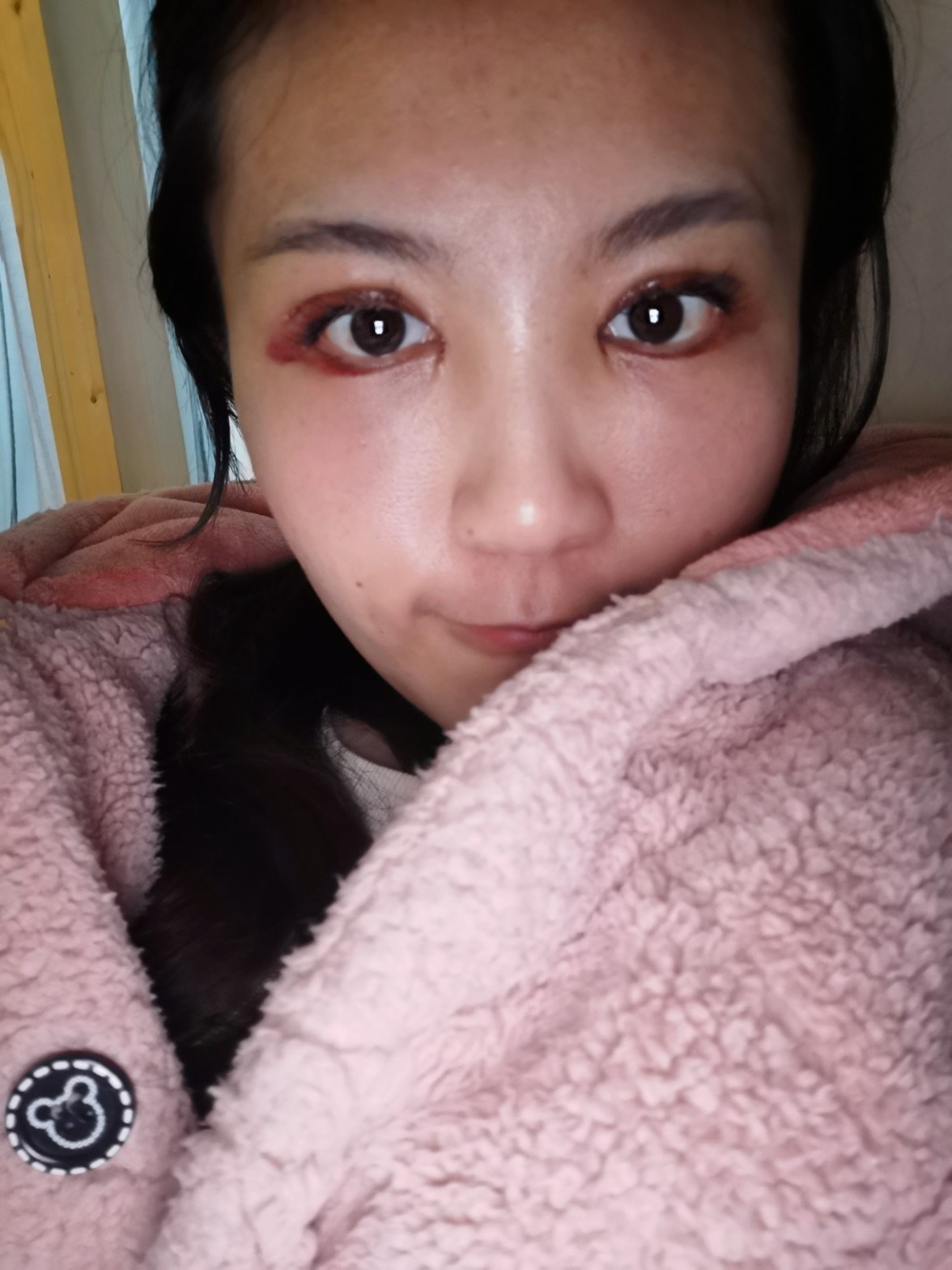 第三天98左眼角突出一个包包,刚做完的时候医生就说有_圈子-新氧
