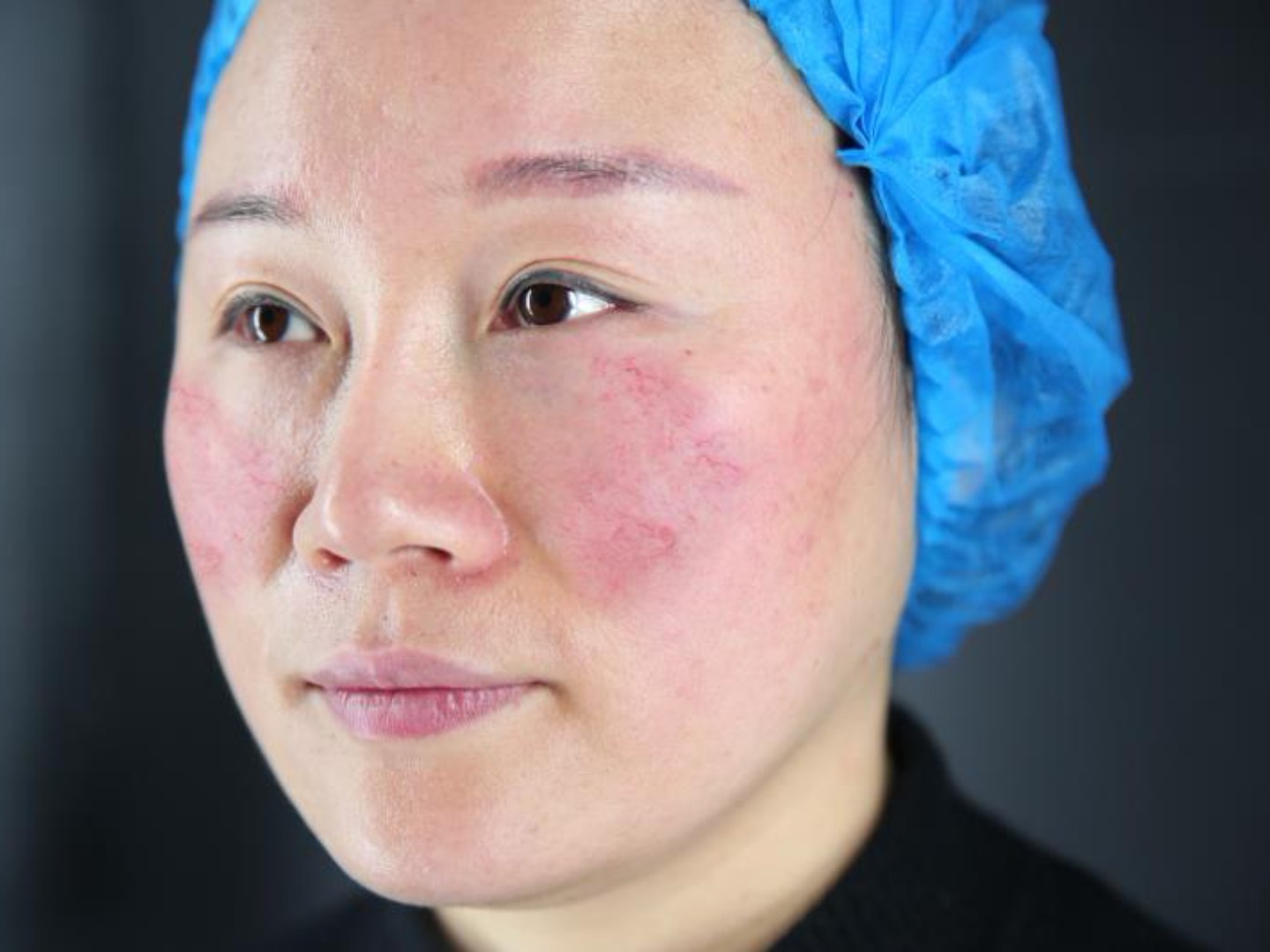 ona祛红血丝术前照