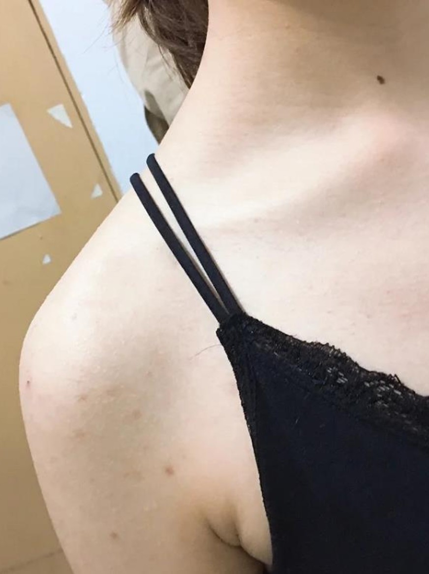 因为有副乳,所以一直以来我穿稍微暴露一点的衣服都是_圈子-新氧美容