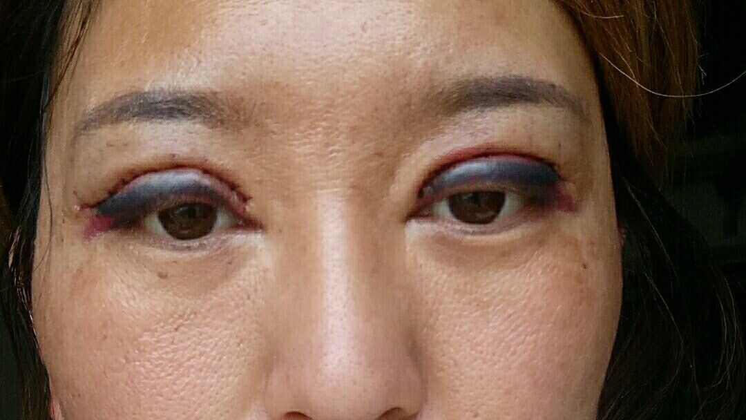 我的大眼综合失败过程