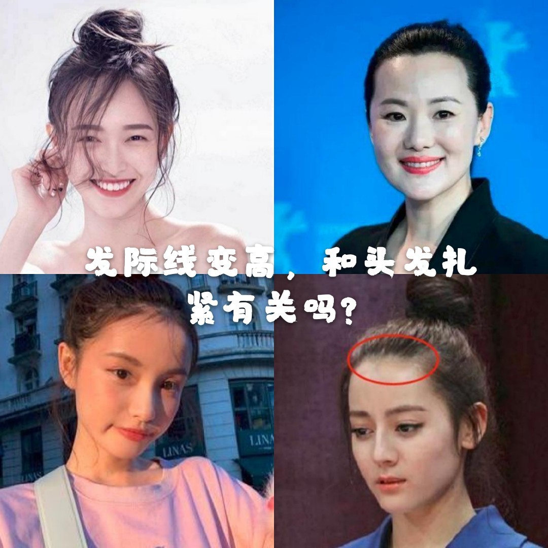 发际线高额头变宽显脸胖两侧三角区头发稀少