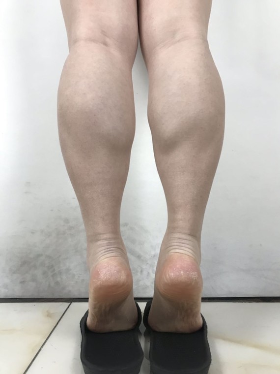 然而亚洲人由于体质关系,肌肉发达型的"萝卜腿"比率非常高,于是瘦小腿