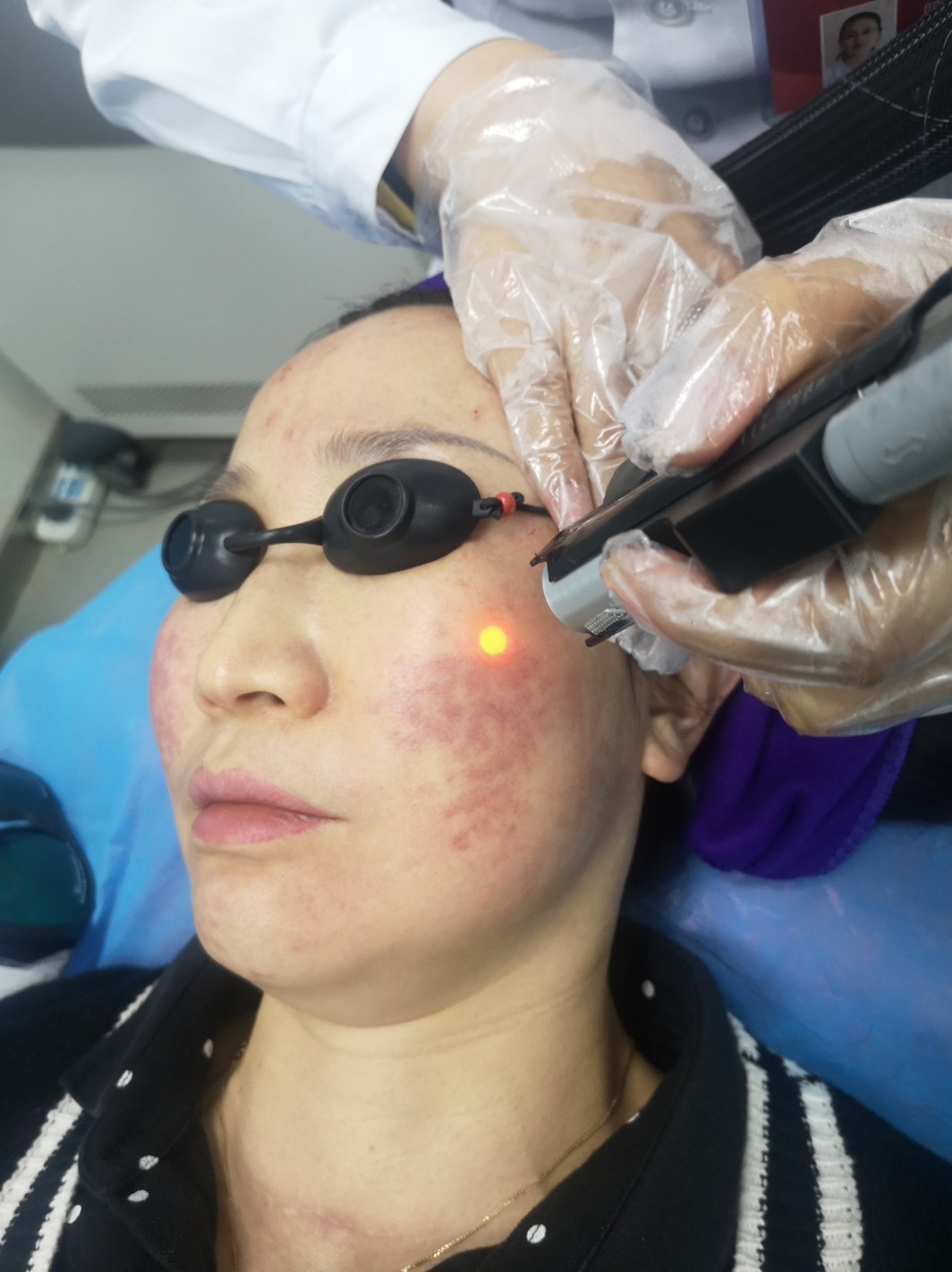 这是我第三次过来做这个激光了,不得不说效果真的太好_圈子-新氧美容