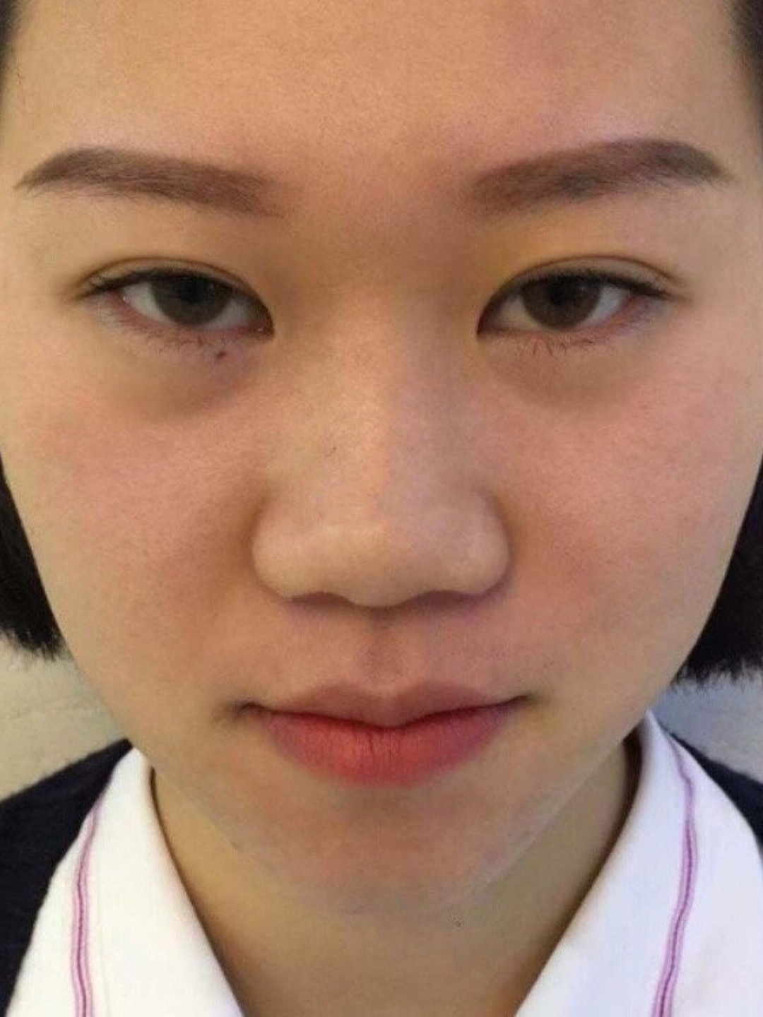 【原韩鼻部多项】我之前的鼻子鼻梁低,整个鼻翼特别宽,_圈子-新氧美容