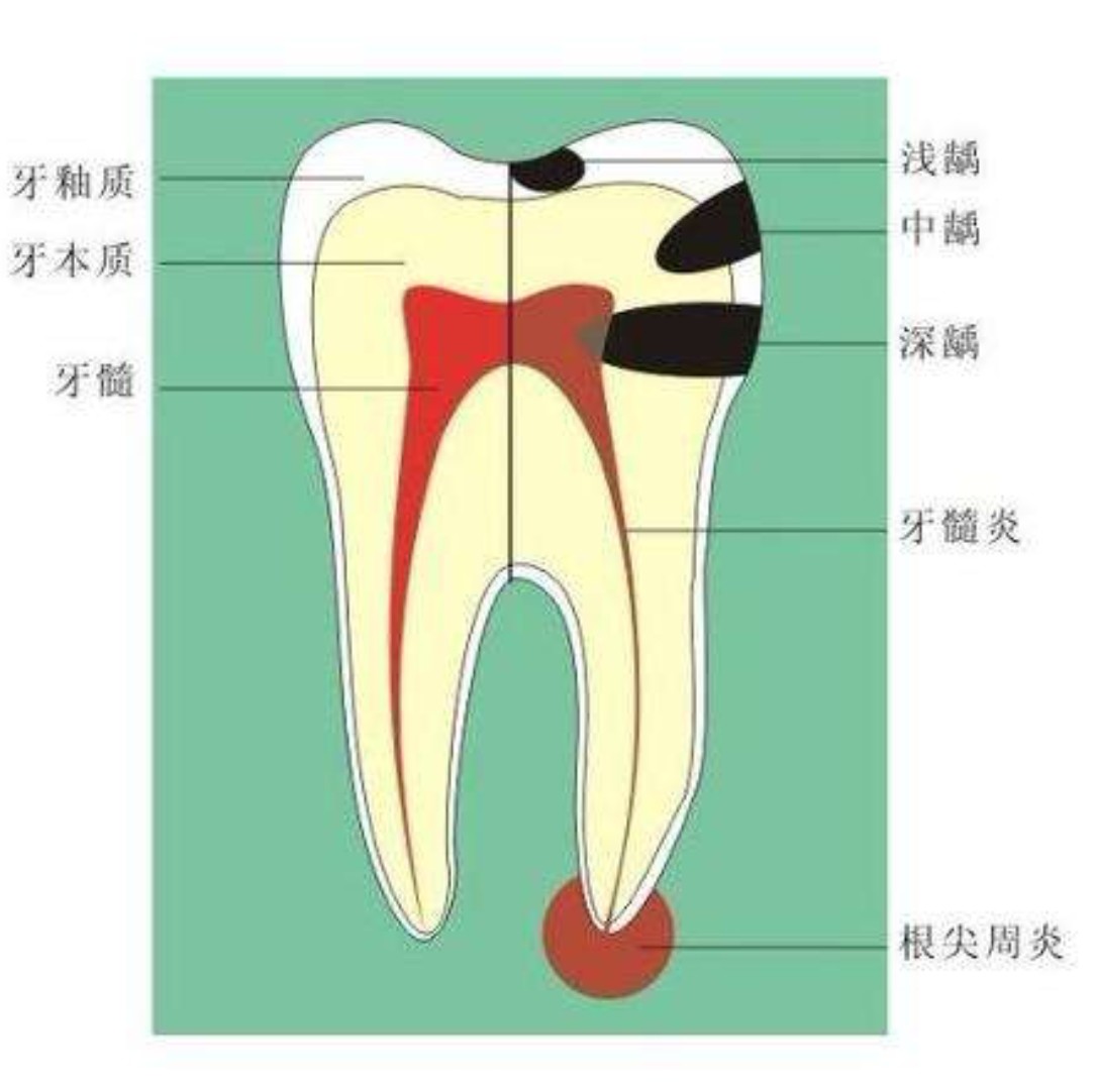 牙髓炎吃药管用吗