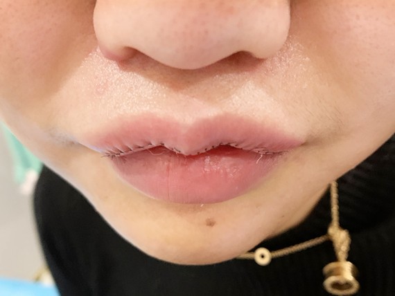 我的原生唇部非常厚唇形模糊化唇妆只能把嘴巴周围用遮