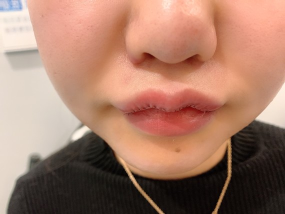 我的原生唇部非常厚唇形模糊化唇妆只能把嘴巴周围用遮