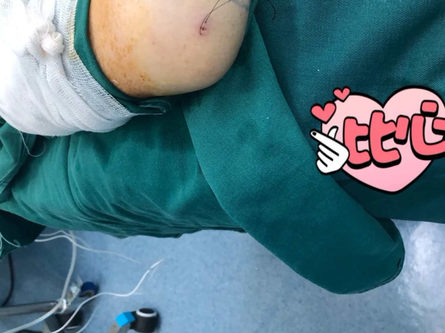 【吸脂】手臂 ,深抽脂浅精雕,科学分离 分层吸脂 【皮肤光滑|血脂率低