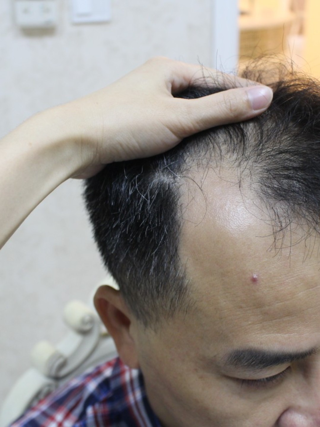 看下图,感觉还是有些稀疏,继续等等种植的头发开始脱_圈子-新氧美容