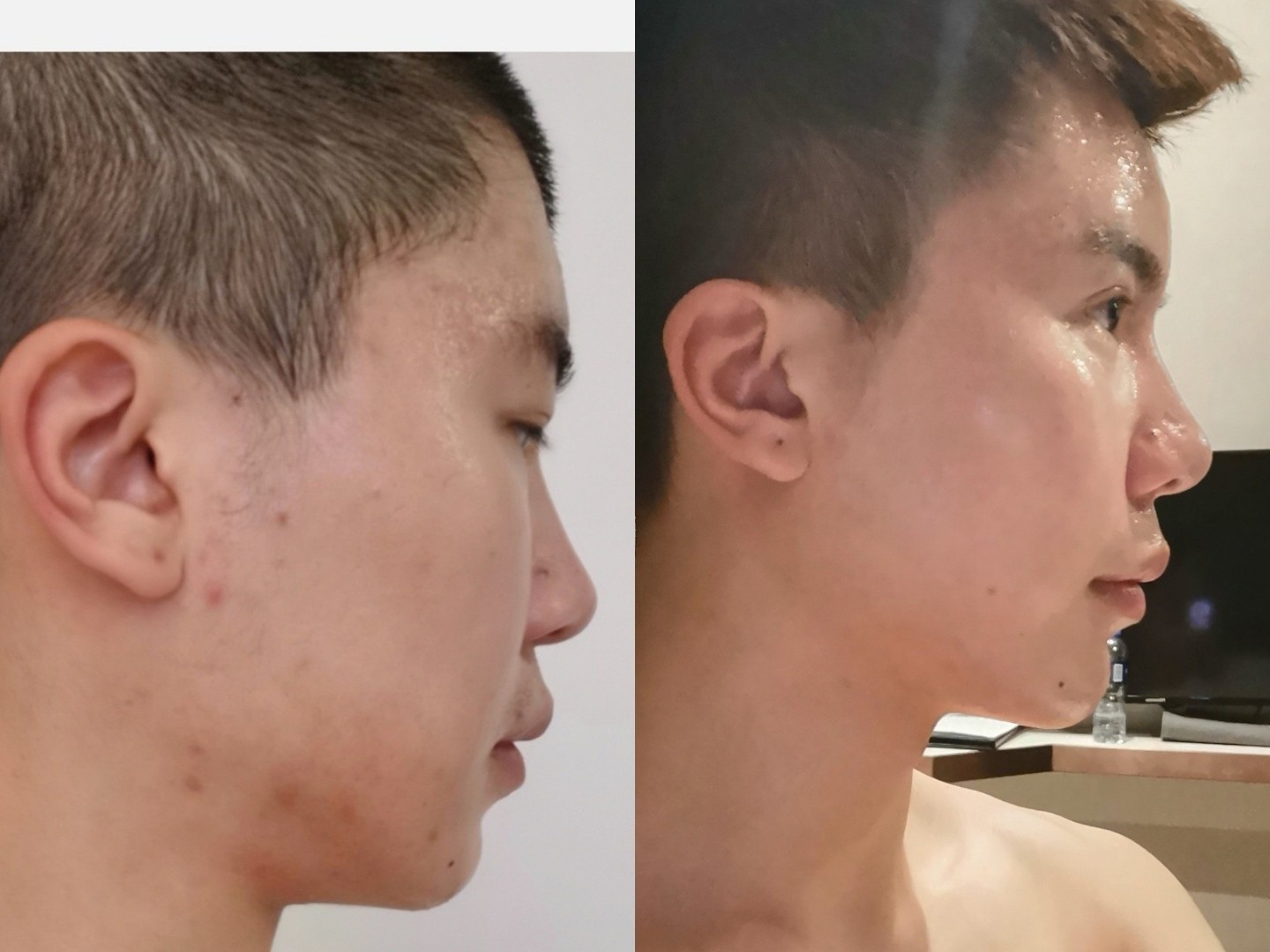 鼻基底凹陷,牙齿伴有骨性_圈子-新氧美容整形