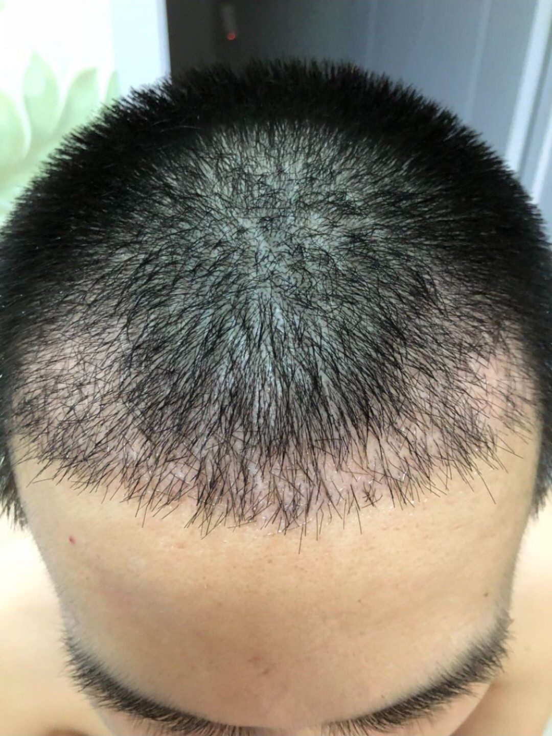 植发断层(植发断层怎么护理)