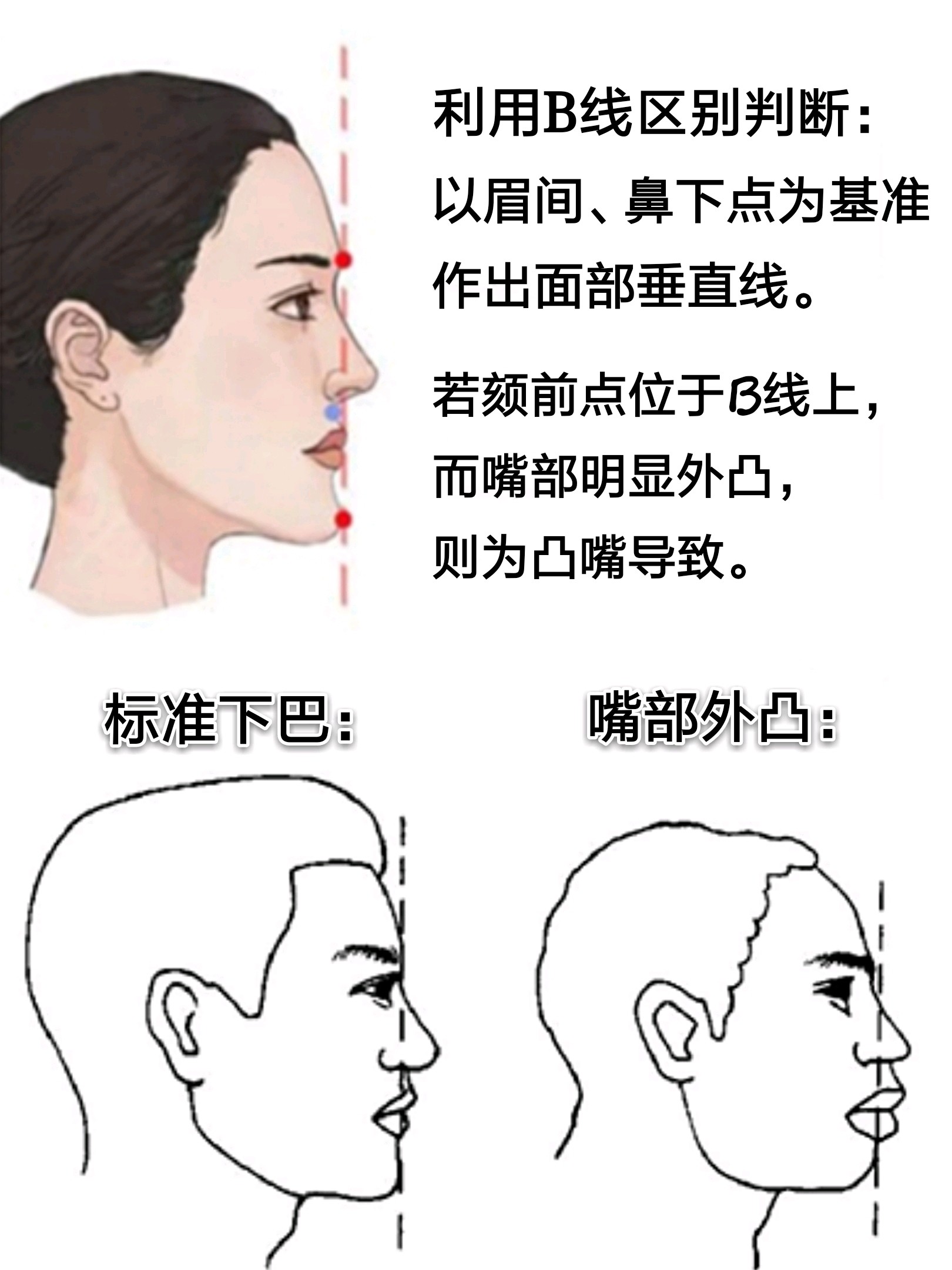 这期我们先来讲讲对于自身下巴后缩问题的辨别与判断方法