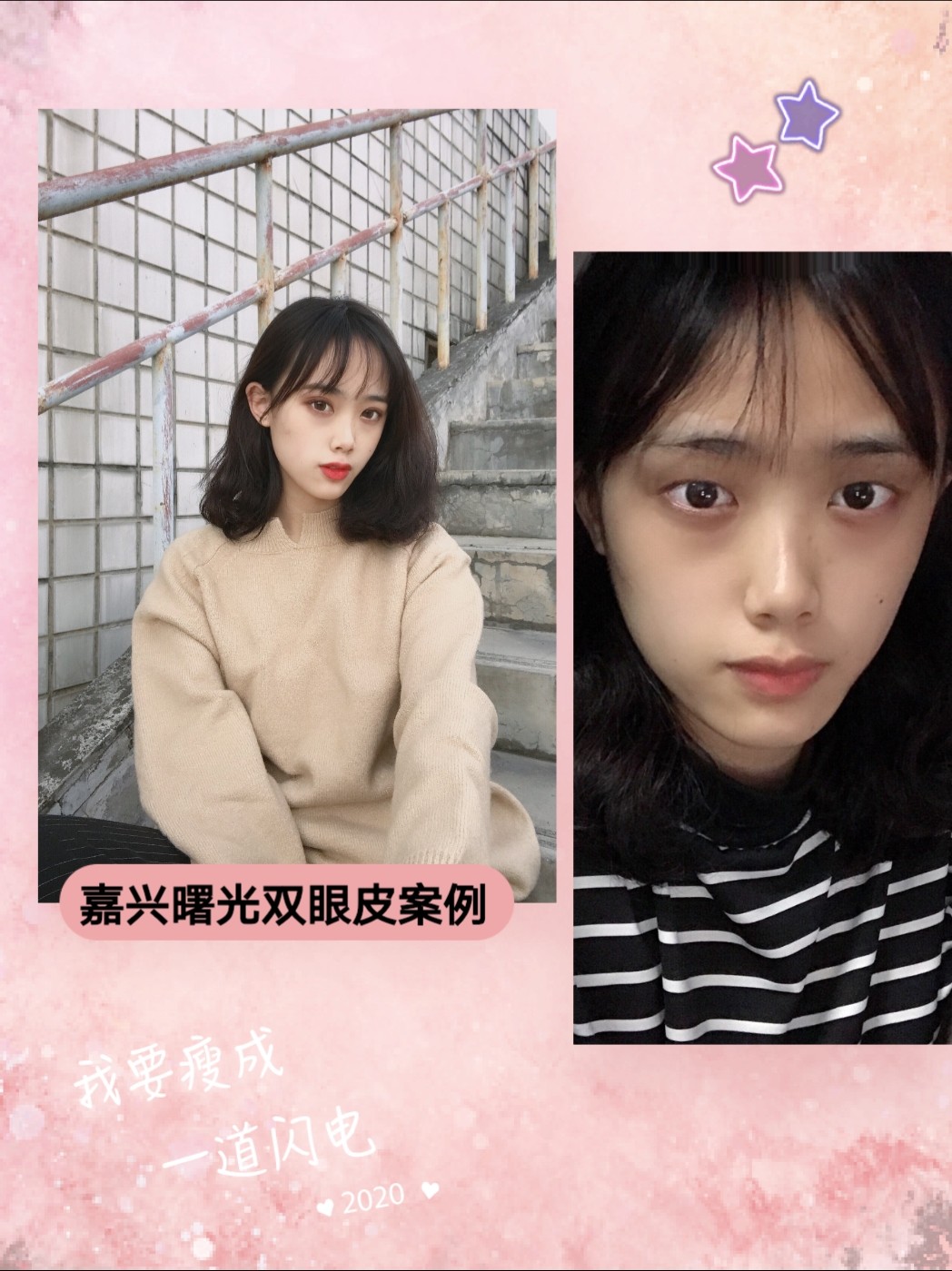 双眼皮出现了下面6种情况 你就该做修复了 眼睛 圈子 新氧美容整形