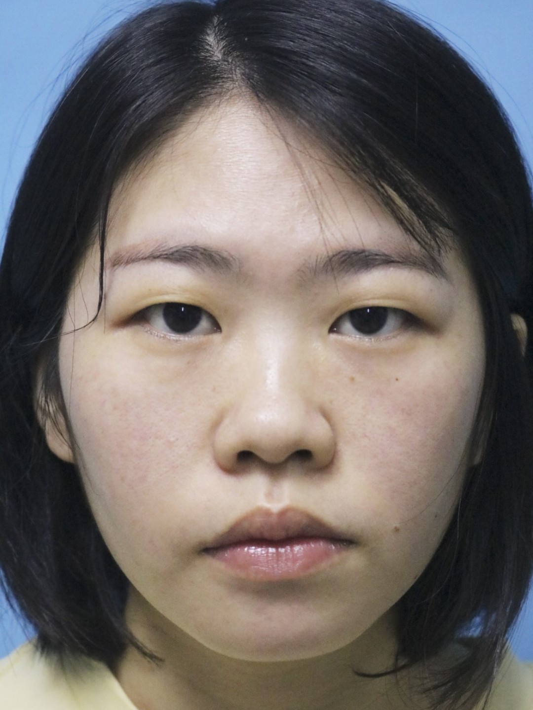 宝宝术前眼皮松弛肿泡导致双眼无神,做完双眼皮术后7_圈子-新氧美容