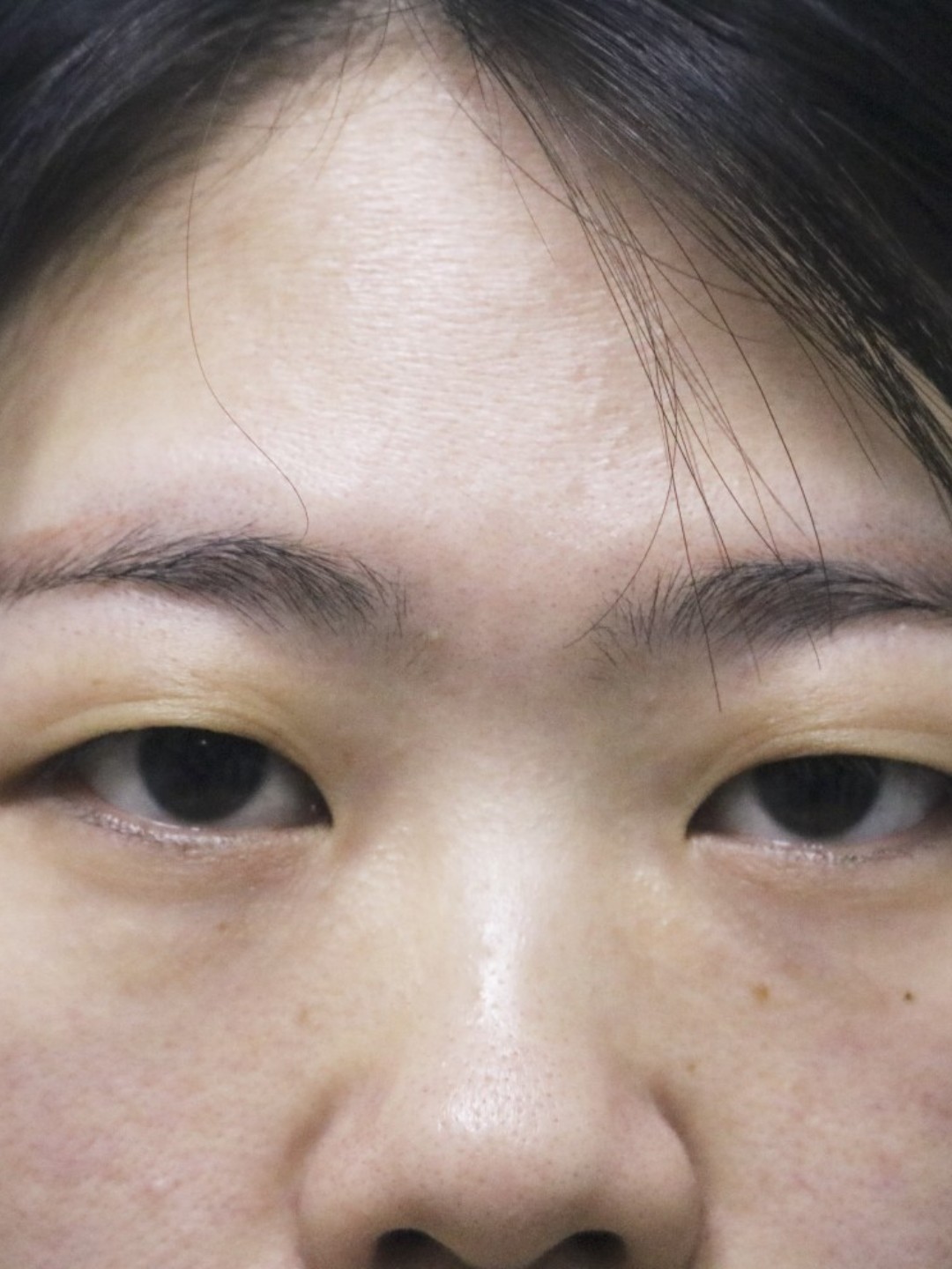 宝宝术前眼皮松弛肿泡导致双眼无神,做完双眼皮术后7_圈子-新氧美容