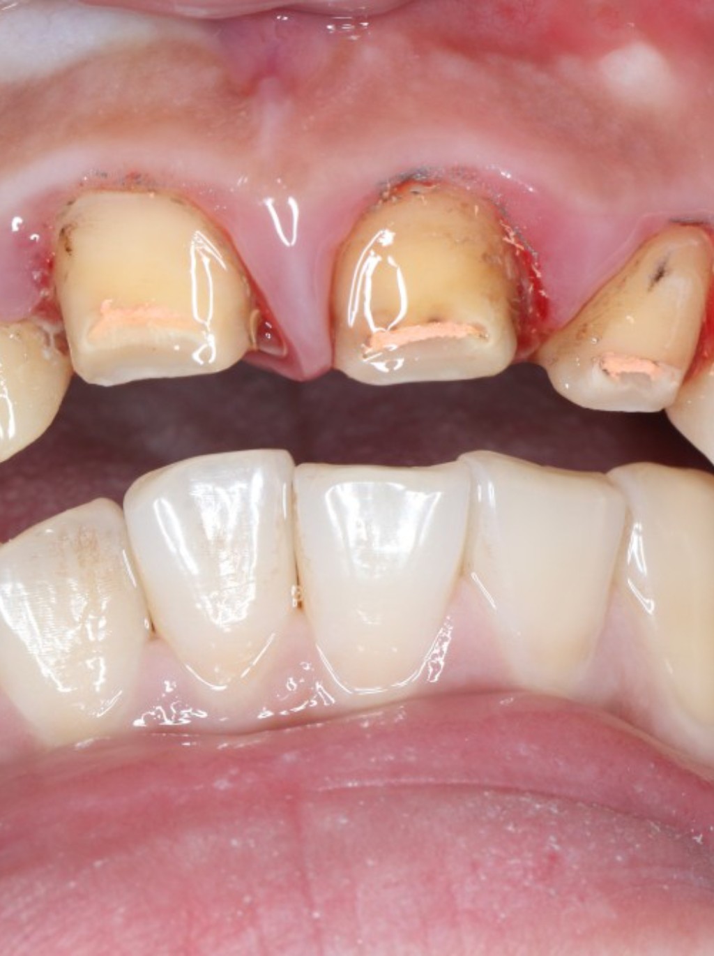 之前在别的地方做的是金属烤瓷牙,一点也不好容易碎掉_圈子-新氧美容