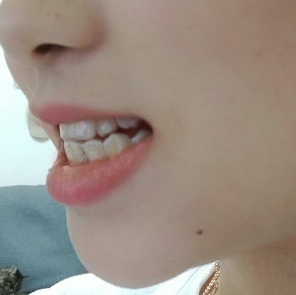 【牙套第一副】因为拔了一颗下面的门牙,现在不戴牙套_圈子-新氧美容