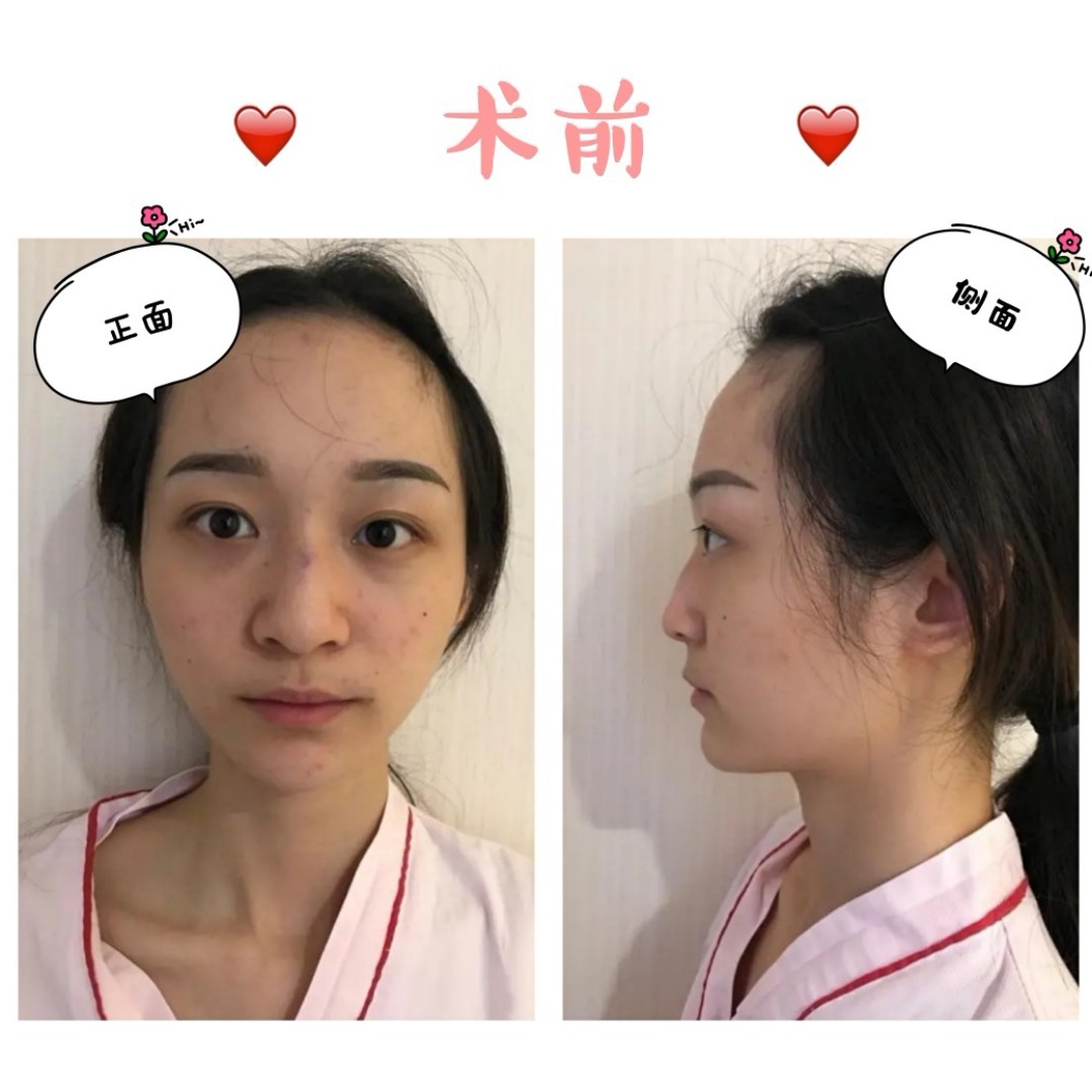 我的鼻部多项手术全过程分享