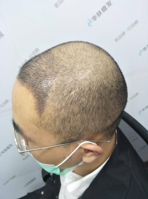 头发种植的手术过程是什么