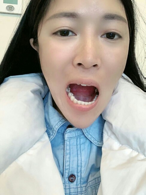 进口种植牙术后第7天